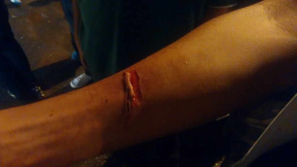 Torcedor ferido com estilhaços após ataque na BR-153 - Foto: Rener Lopes/Agência EB